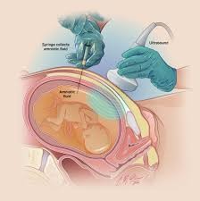 Amniocentesis